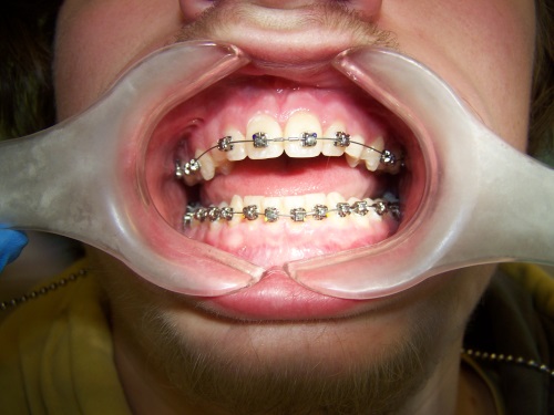 Zahnarzt Dr. Brietze: Kieferorthopädie Beispiel 1
