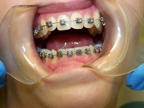 Zahnarzt Dr. Brietze: Kieferorthopädie Beispiel 2