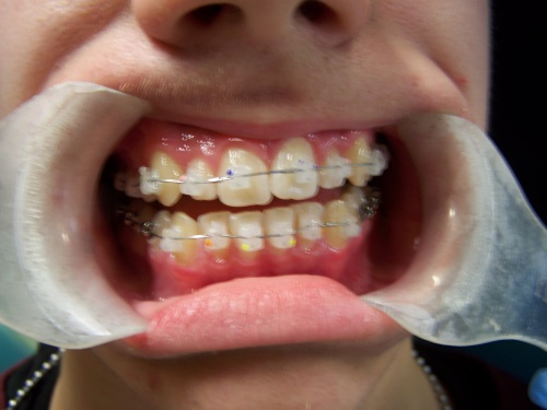 Zahnarzt Dr. Brietze: Kieferorthopädie Beispiel 4