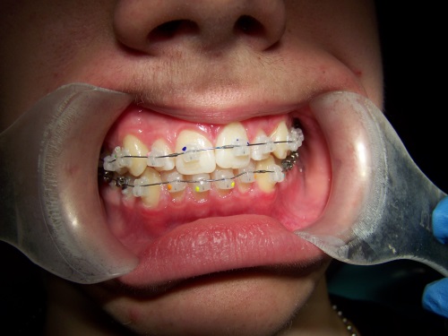 Zahnarzt Dr. Brietze: Kieferorthopädie Beispiel 5