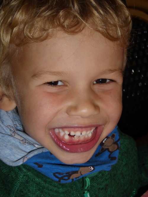 Zahnarzt Dr. Brietze: Leistungen Kinderbehandlung Beispiel 1