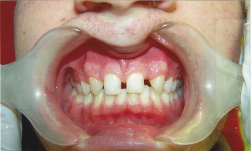 Zahnarzt Dr. Brietze: Leistungen Beispiel Veneers 3 (vorher)