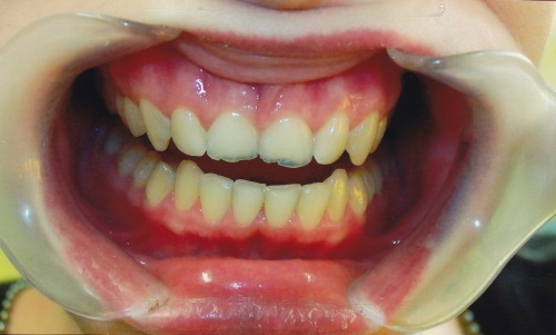 Zahnarzt Dr. Brietze: Leistungen Beispiel Lumineers (vorher)