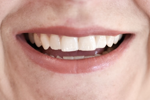 Zahnarzt Dr. Brietze: Smile Makeover - nachher 2