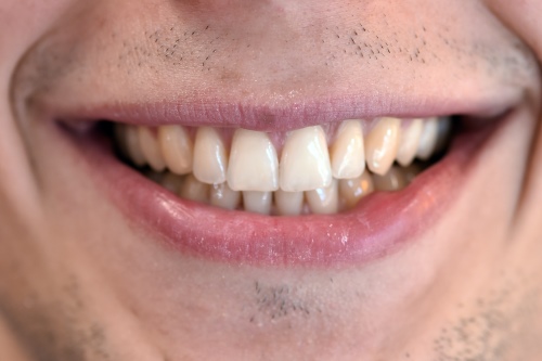 Zahnarzt Dr. Brietze: Smile Makeover - nachher 3