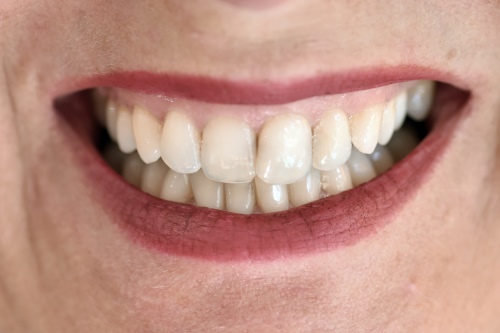Zahnarzt Dr. Brietze: Smile Makeover - nachher 4