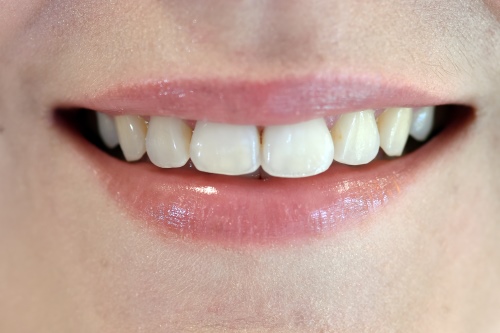 Zahnarzt Dr. Brietze: Smile Makeover - nachher 5