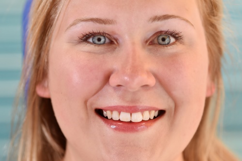 Zahnarzt Dr. Brietze: Smile Makeover - nachher 6