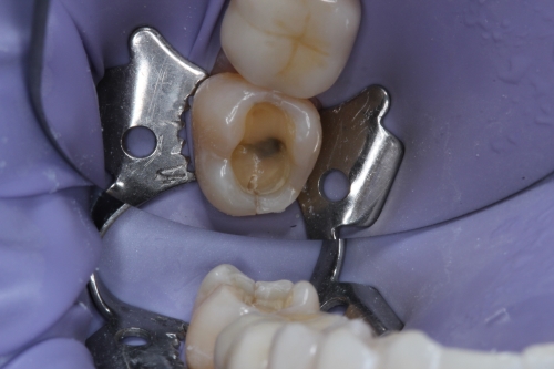 Zahnarzt Dr. Brietze: Leistungen Beispiel Füllungen Patient 1
