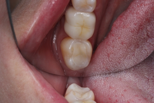 Zahnarzt Dr. Brietze: Leistungen Beispiel Füllungen Patient 1