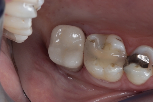 Zahnarzt Dr. Brietze: Leistungen Beispiel Füllungen Patient 2