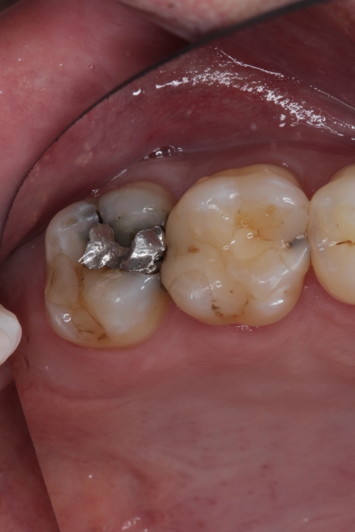 Zahnarzt Dr. Brietze: Leistungen Beispiel Füllungen Patient 3