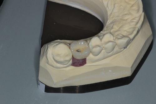 Zahnarzt Dr. Brietze: Leistungen Beispiel Implantologie 1