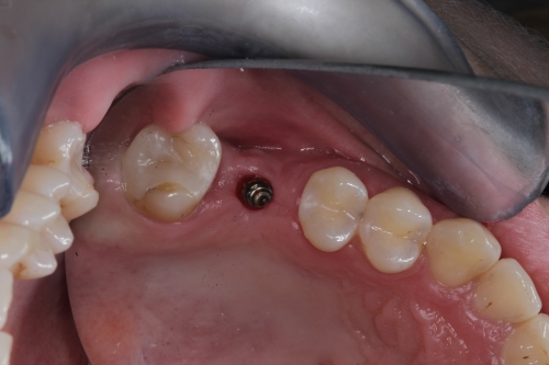 Zahnarzt Dr. Brietze: Leistungen Beispiel Implantologie 2