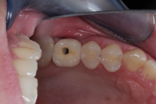 Zahnarzt Dr. Brietze: Leistungen Beispiel Implantologie 3