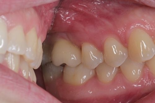 Zahnarzt Dr. Brietze: Leistungen Beispiel Implantologie 4