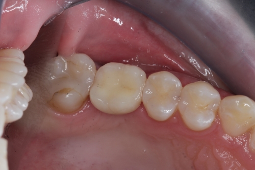 Implantologie: Beispiel 5 Zahnarzt Dr. Brietze: Leistungen Beispiel Implantologie 5