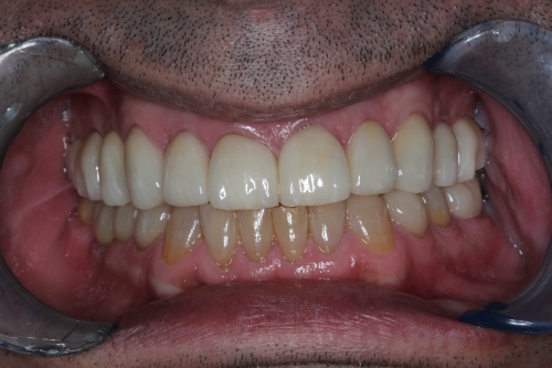 Smile Makeover: Patient 1 nachher Zahnarzt Dr. Brietze: Smile Makeover - Patient 1 nachher