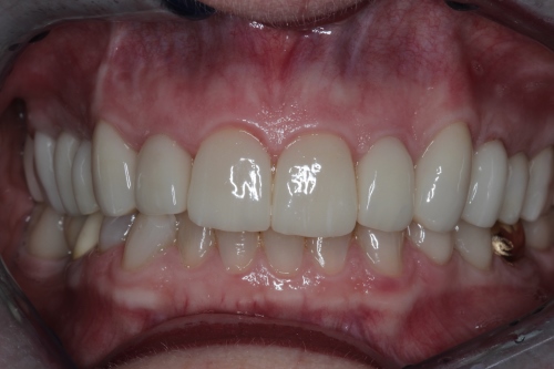 Zahnarzt Dr. Brietze: Smile Makeover - Patient 1 vorher