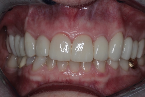 Smile Makeover: Patient 2 nachher Zahnarzt Dr. Brietze: Smile Makeover - Patient 1 vorher