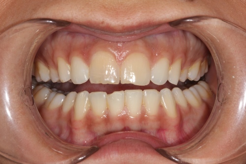 Zahnarzt Dr. Brietze: Leistungen Beispiel Veneers 1 (vorher)