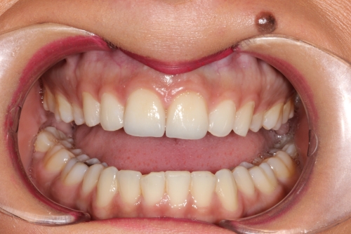 Zahnarzt Dr. Brietze: Leistungen Beispiel Veneers 2 (nachher)